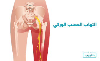 التهاب العصب الوركي ومكان تموضعه