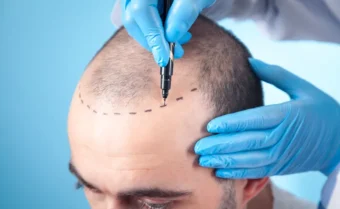 هناك أنواع عديدة لعملية زراعة الشعر، ويتم اختيار الأفضل بناءً على حالة المريض.