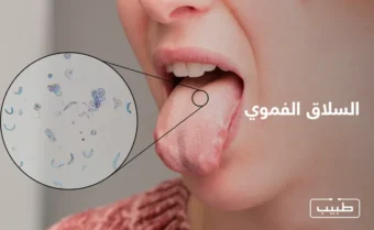 يظهر السلاق الفموي عند الأطفال كطلاء أبيض على اللسان يشبه الجبن