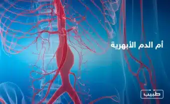 يعتقد أن هنالك دور للأمراض الوراثية والتاريخ العائلي في تطور أم الدم الأبهرية